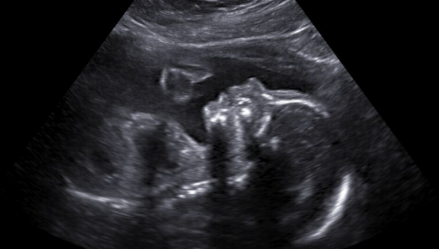 sneak preview ultrasound