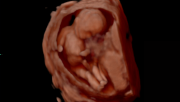 sneak a peek ultrasound