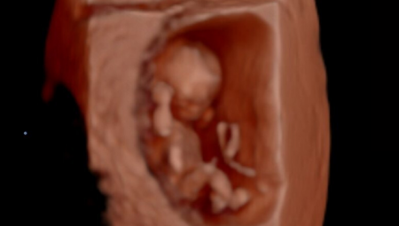 sneak a peek 3d 4d ultrasound