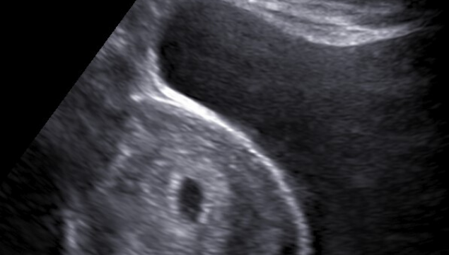 sneak a peek ultrasound