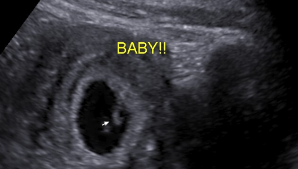 Gallery - Sneak A Peek Ultrasound